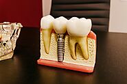 Caring for Your Dental Implants: Tips for Long-Lasting Results