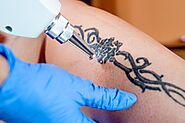 Tattoo removal - Prime Skin Clinic, Kannur