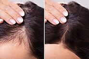 Hair Loss Treatment - Prime Skin Clinic, Kannur