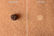 Birth Marks & Mole Removal - Prime Skin Clinic, Kannur