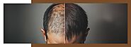 THE PROCESS OF HAIR TRANSPLANTATION: WHAT TO EXPECT?