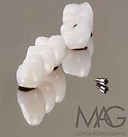 implantes
