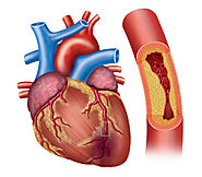 How To Check Heart Blockage At Home?