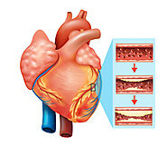 How To Check Heart Blockage At Home?