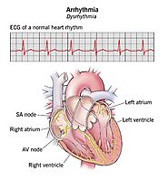 Understanding Heart Arrhythmia Types