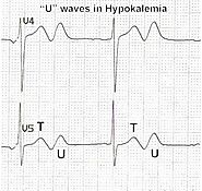 Detecting Hypokalemia ECG: Key Signs To Watch For