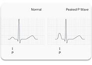 Atrial Depolarization: Understanding Heart’s Electrical Signals