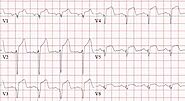 Understanding MI ECG: A Comprehensive Guide To Myocardial Infarction Detection