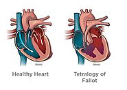 Understanding Tetralogy Of Fallot Pathophysiology: A Comprehensive Overview