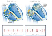 AFib Definition: Simple Definition And Medical Insights