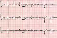 Understanding A Normal ECG Report: A Comprehensive Guide