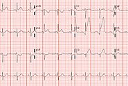 Understanding STEMI ECG: The Key To Identifying A Heart Attack