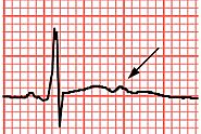 U Wave In ECG: A Deep Dive Into Cardiac Health Monitoring