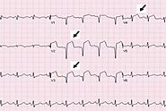 Understanding Anteroseptal Myocardial Infarction ECG: A Comprehensive Analysis