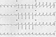 Understanding Ischemia ECG: A Comprehensive Guide