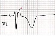 Understanding Epsilon Wave ECG: A Crucial Indicator in Cardiology