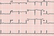 Understanding Atrial Flutter ECG: Detection, Symptoms, and Treatment