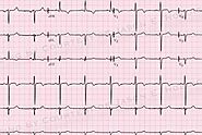 Understanding Dextrocardia ECG: Diagnosis, Implications, and Management