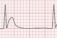 Understanding Hypercalcemia ECG: Diagnosis, Symptoms, and Treatment