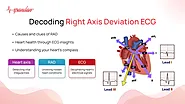 Decoding Right Axis Deviation ECG