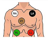 Optimal ECG Lead Placement: Key Tips For Accurate Readings