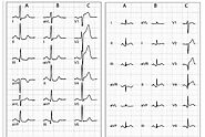 Understanding LAD ECG: A Comprehensive Guide