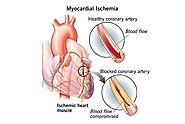 IHD Full Form in Medical Context