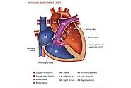 Understanding Acyanotic Congenital Heart Disease