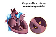 Understanding the Symptoms of Hole in Heart in Adults