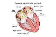 Understanding Paroxysmal Supraventricular Tachycardia (PSVT)