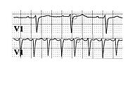 Demystifying AVNRT ECG: A Complete Guide