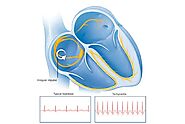 Tachycardia Explained: When heart rate exceeds 100 BPM