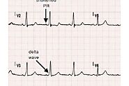 Decoding Delta Wave ECG: A Comprehensive Guide