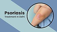 A Detailed Guide on Psoriasis and Its Treatment