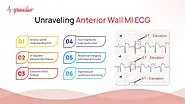 Unraveling Anterior Wall MI ECG