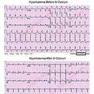 Understanding Hyperkalemia ECG Changes: A Comprehensive Guide For Clinicians