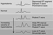 Understanding Hypokalemia ECG Changes: A Comprehensive Guide For Clinicians