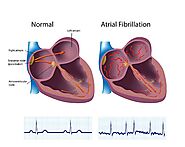 Treatment For Afib: Explore All Atrial Fibrillation Treatments