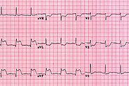 Understanding Inferior Wall MI ECG: A Quick Guide