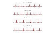 What Are The Different Types Of Arrhythmias?