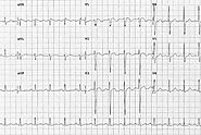 Decoding Pulmonary Embolism ECG: Key Patterns To Watch For