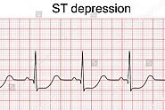 Understanding ST Depression: A Key Indicator In Cardiology