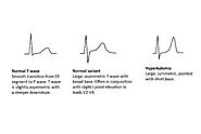 Understanding T Wave Abnormality: Symptoms, causes and treatment