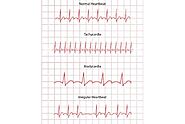 What is the Difference between Tachycardia and Bradycardia?