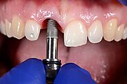 Post-Procedure Care for Dental Implants | Pinnacle Peak Dentistry