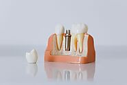 Find Your Best Option Between Dental Implants vs. Dentures | Pinnacle Peak Dentistry