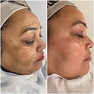 Best Pigmentation Treatment in Chandigarh - Clinic Gleuhr