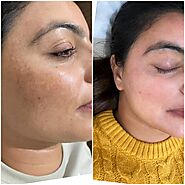 Best Pigmentation Treatment in Chandigarh at Gleuhr