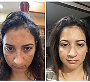 Best Pigmentation Treatment in Chandigarh at Gleuhr