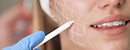 Buccal Pad Fat Removal Procedure